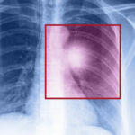 Lung cancer – Types, symptoms, and causes